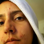 Domácí masky v boji proti akné